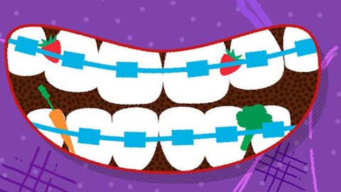 Logo of Foods to avoid when you have braces